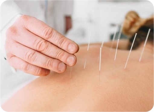 Accupuncture